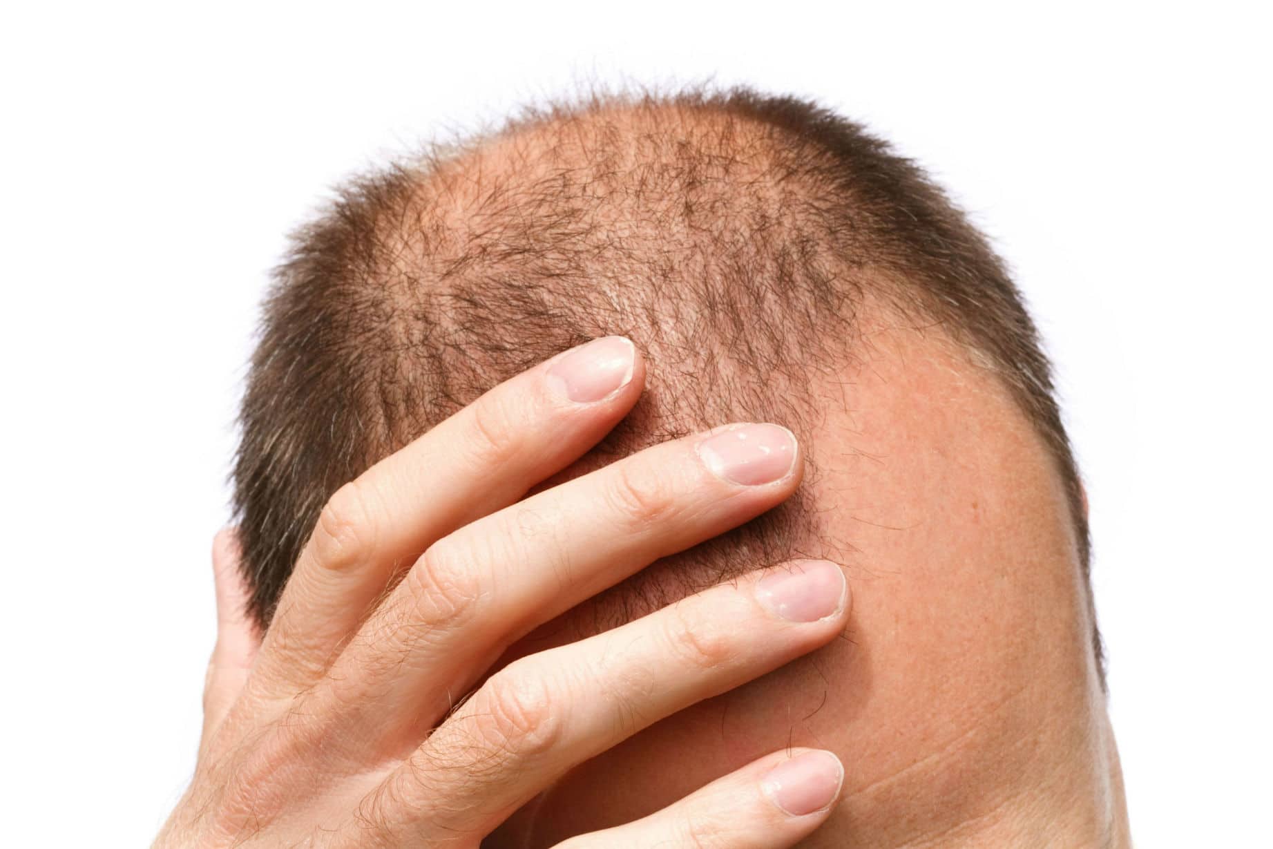 Close-up of a person's head with thinning hair, touching their scalp.